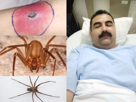 Investiga la CDH de Puebla presunta negligencia m&eacute;dica en muerte de bombero por picadura de ara&ntilde;a violinista