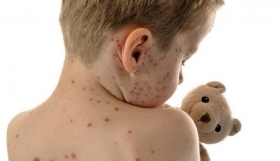 En redes se alarm&oacute; por la confirmaci&oacute;n de casos en M&eacute;xico.