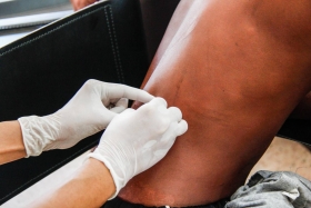 Lepra no es problema de salud p&uacute;blica en Puebla.